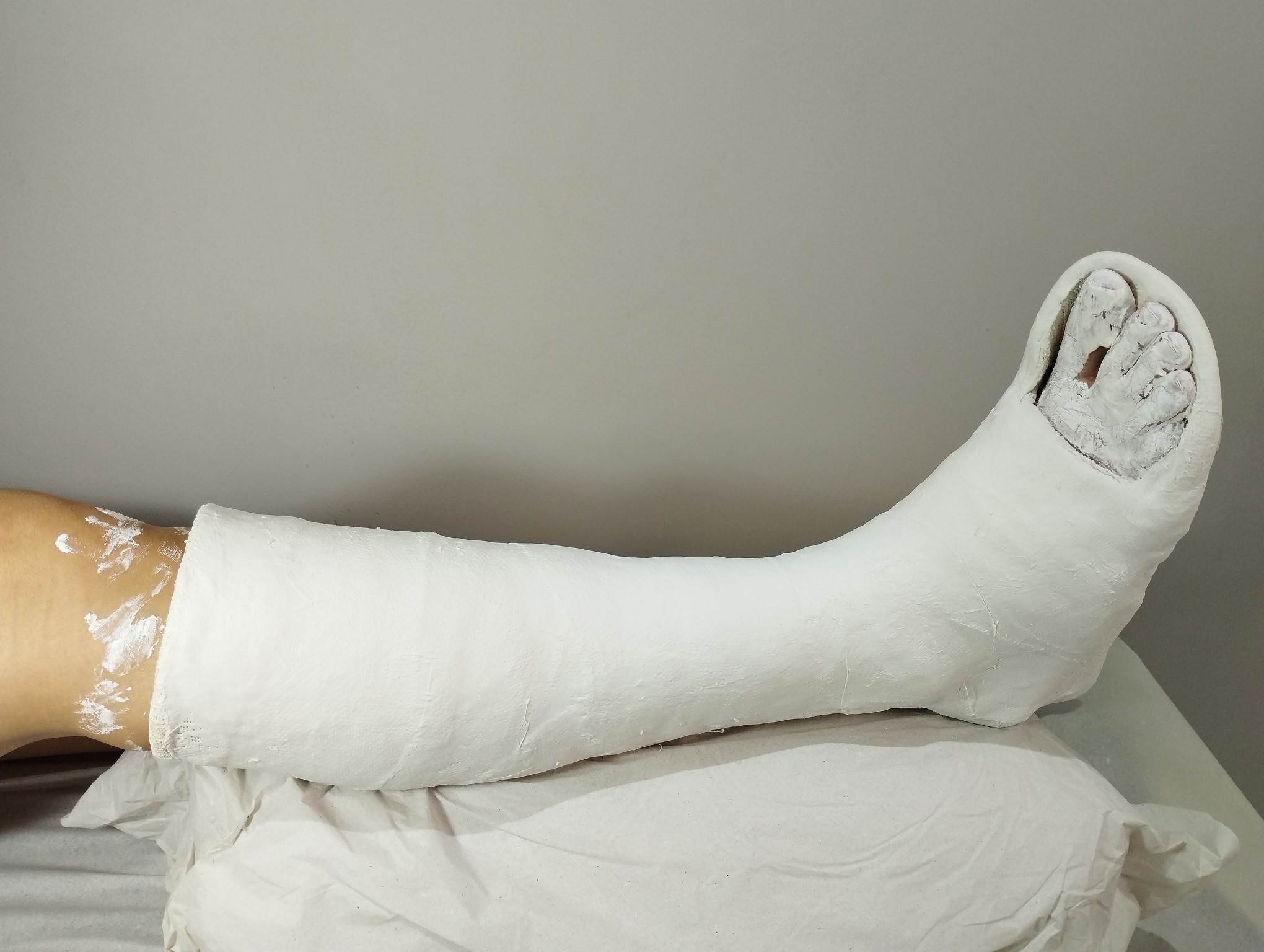 Here you can find photos and videos of patients with casts in the hospital.