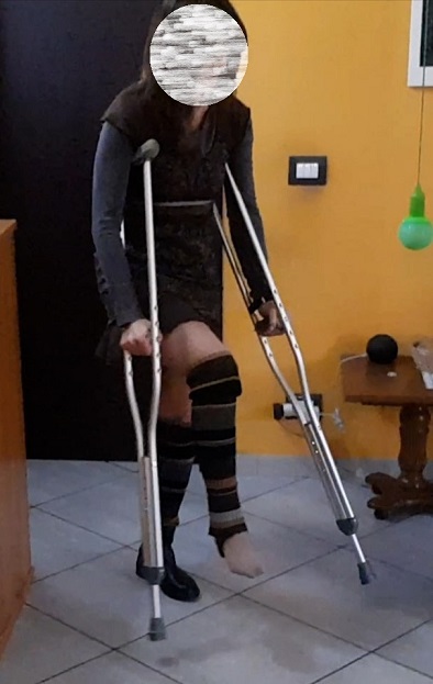 Wife sprained her right ankle. She can't put her foot on the ground. She takes her underarm crutches. She wears only one shoe, and only pantyhose on her injured foot. Fantastic sprains videos. Vid 5:12.