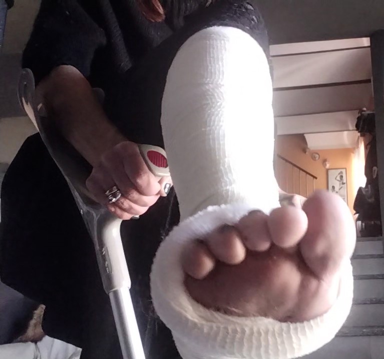 Drienne wears a white slc at home. She plays with her white slc. She moves around houses on her crutches. Vid 6:51
