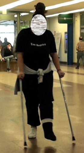 This girl broke her left ankle. She wears a big white SLC, covered by a black sock. She moves on her crutches. Vid 7:29