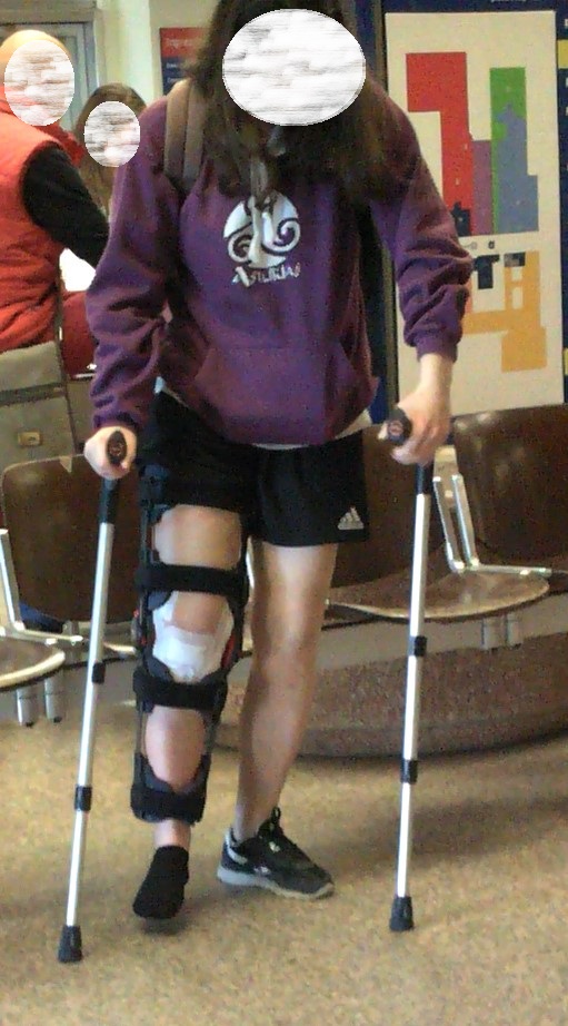 This beautiful girl broke her left knee. She is wearing a knee brace. She is not wearing the shoe, but a black sock. She wiggles his toes a lot. She leaves on her crutches. Vid 4:32