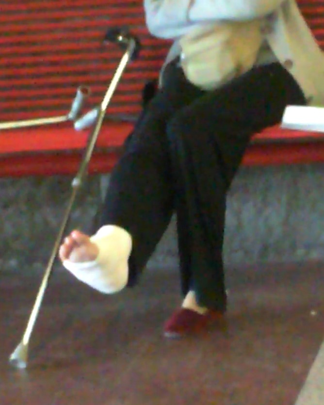 This woman broke her right ankle. She is wearing a white SLC. She arrives on her crutches, with slc covered by a white sock. Then I can admire his fingers coming out of his cast. Vid 7:11