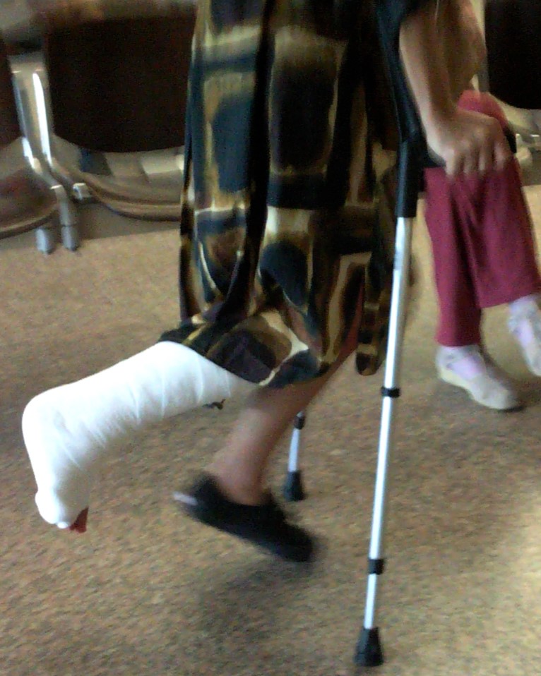This beautiful lady broke her right ankle.  She's wearing a big white SLC,  with her toes exposed.  She moves on her crutches.  Vid 14:45.