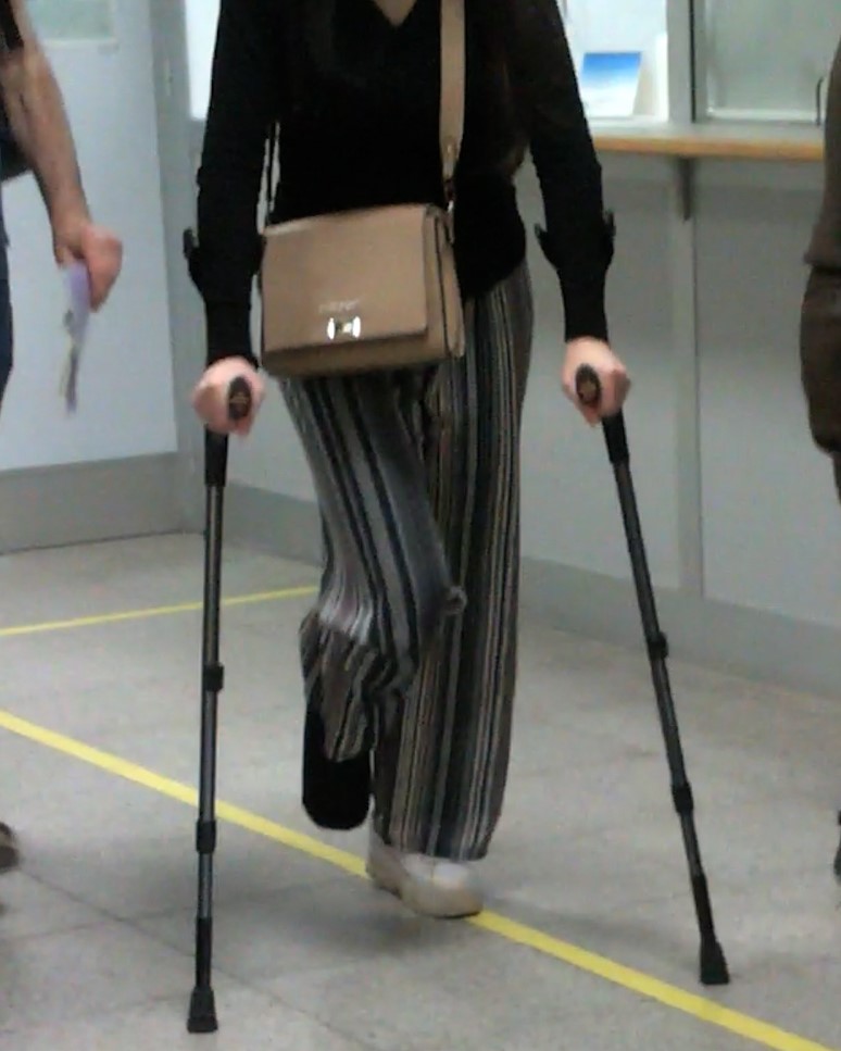 This gorgeous girl broke her right ankle.  She wears an SLC entirely  covered by a black sock.  She moves around on her crutches.  Vid 9:10