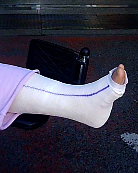 This girl broke her left ankle.  She wears a white Slc with her fingers exposed.  She is sitting in a wheelchair.  Nice close-ups on his Slc. Vid 5:46