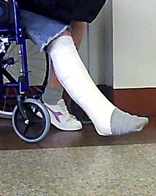 Italian-legcast-crutching-wheelchair-sprain