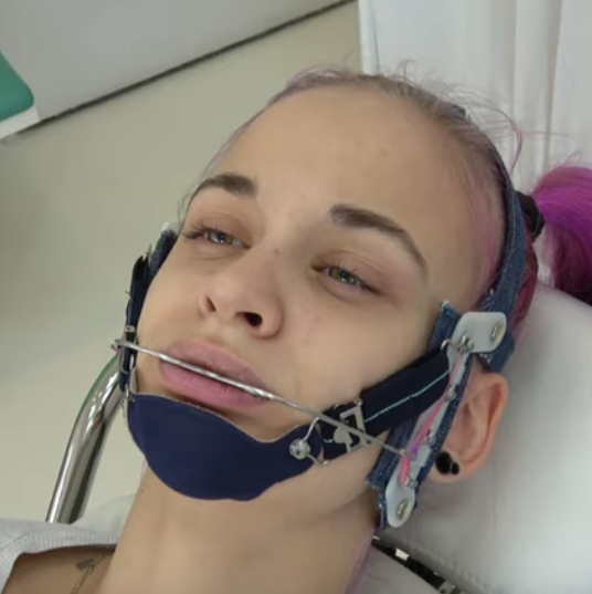 Pink Hair Headgear Girl gets Permanent Orthodontic Headgear