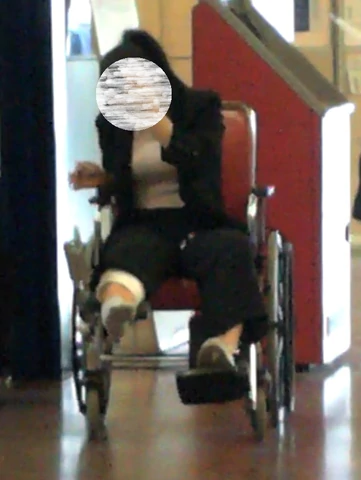 She broke her right knee. She arrives on her crutches. She is wearing only one shoe, and a gray sock. As she is slow on crutches then she gets a wheelchair. When she is seated you can see her cylinder legcast on her knee under her pants.