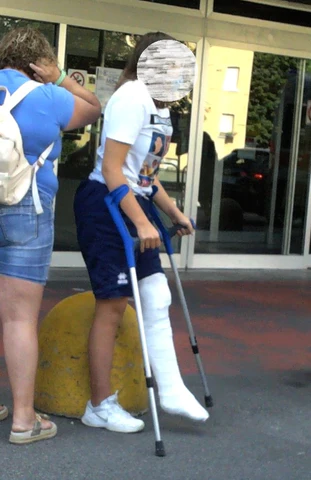 This woman broke her left leg. She arrives on crutches. Her left leg is in a beautiful white full leg plaster cast (LLC). 