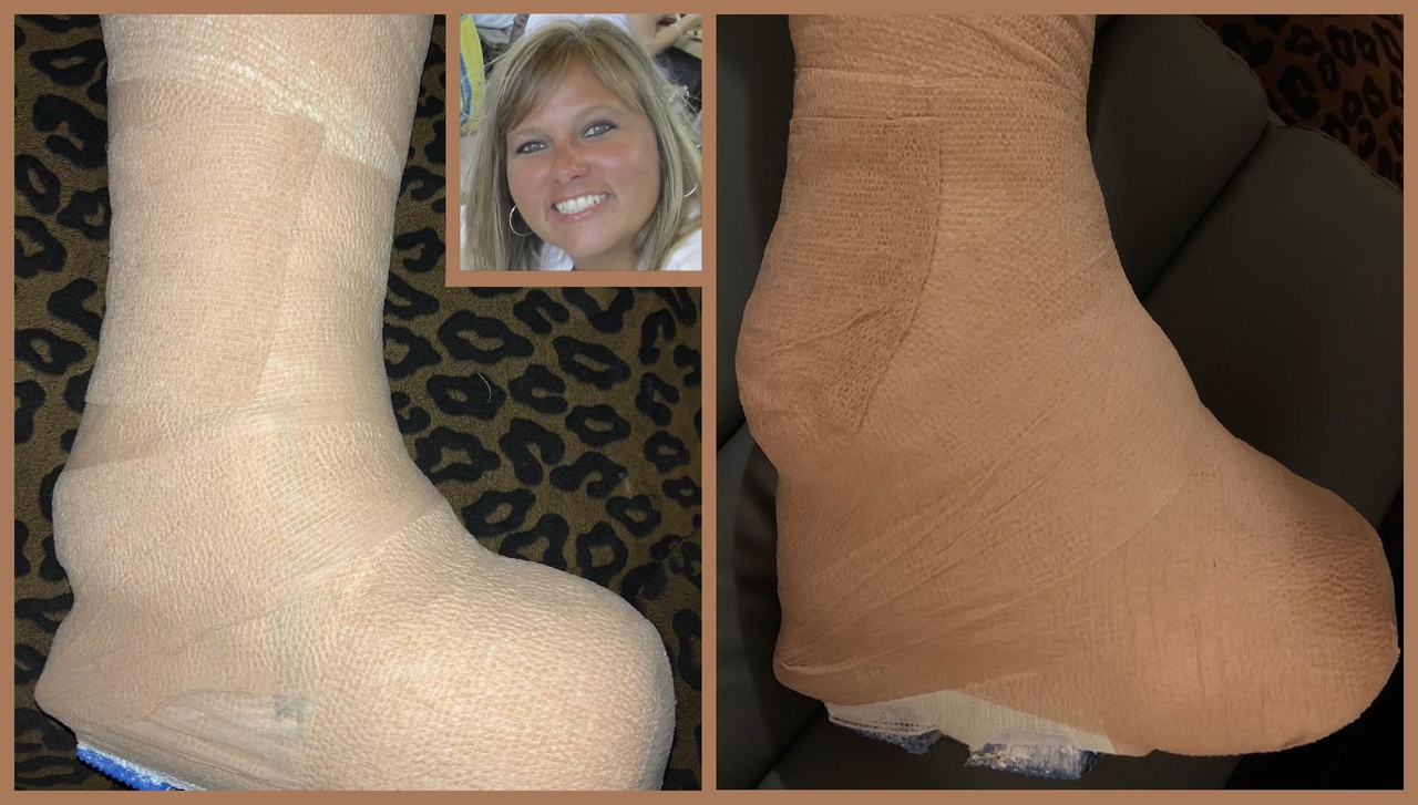 Treating plantarfasciitis, tarsaltunnelsyndrome, heeltendinitis and ankletendinitis in a total contact cast. This woman's foot is completely encased in plaster since september. Latest cast ist high-heeled!