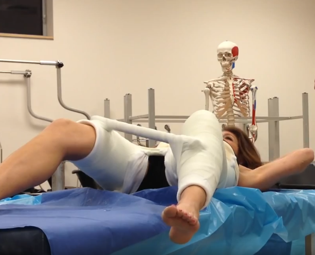 Instructional video: application of a hip-spica cast on adults. patient is immobilized in a 1.5 hipspica cast. this cast extends from the armpits to the ankle of the left leg, the right leg is enclosed above the knee. a spreader bar is installed.